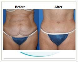 Slider image (5) Aesthetic Cosmetic Plastic Surgery Center Bolivia - SensualBodyDream